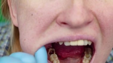 Derin çürük, açık kanallar, Kanal temizleme. Stomatolon giriş, periodontitis tedavi üzerinde hastaya