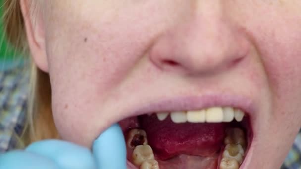 深蛀牙 开阔的运河 清洁运河 入院时的口腔激素患者 牙周炎治疗 — 图库视频影像