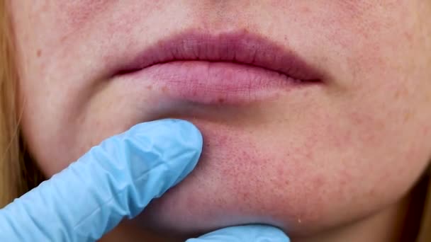 Brufoli Sul Mento Pelle Problematica Acne Sul Viso Esame Parte — Video Stock