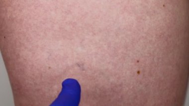 Kız bacak kılcal mesh. Mavi silikon eldiven doktor kılcal damar hasarı inceler