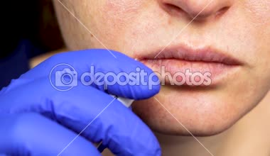 Dudaklarında uçuk: nezle ve herpes virüsü bir kadınla bir dermatolog ve enfeksiyon hastalıkları uzmanı tarafından muayene