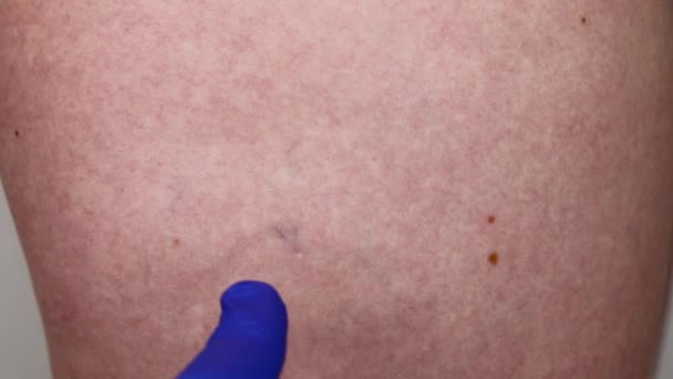 少女の脚にキャピラリー メッシュ 青いシリコーン手袋で医師は毛細血管に損傷を調べる — ストック動画