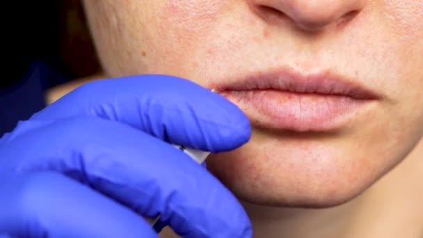 Herpes Lippen Een Vrouw Met Een Koude Het Herpesvirus Wordt — Stockvideo