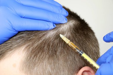 Saç MEZOTERAPİSİ veya saç ekimi: Güzellik Uzmanı Doktor yapıyor enjeksiyonları içinde kafa saç büyümesi için veya kellik önlemek için mans