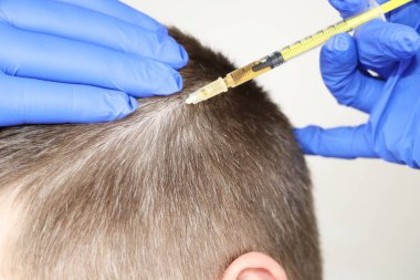 Saç MEZOTERAPİSİ veya saç ekimi: Güzellik Uzmanı Doktor yapıyor enjeksiyonları içinde kafa saç büyümesi için veya kellik önlemek için mans