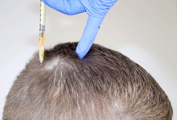 Mezoterapia Włosów Lub Przeszczep Włosów Kosmetyczka Lekarz Robi Zastrzyki Mans — Zdjęcie stockowe