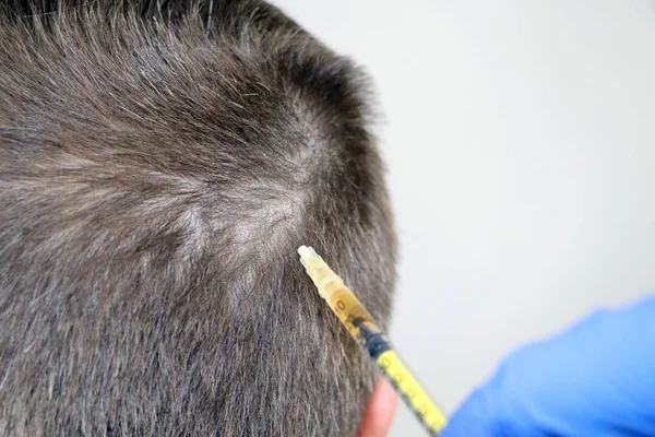 Haarmesotherapie Oder Haartransplantation Kosmetikerin Arzt Macht Injektionen Den Kopf Des — Stockfoto