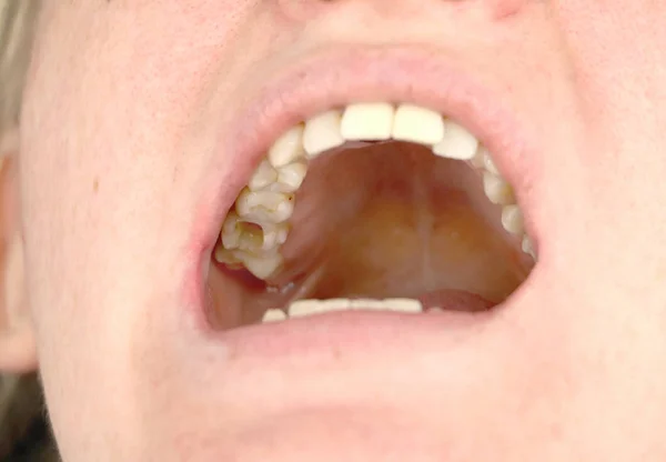 Het Gat Tand Behandeling Van Tandheelkundige Grachten Behandeling Van Parodontitis — Stockfoto