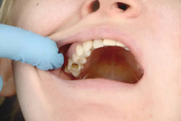 Orificio Diente Tratamiento Los Canales Dentales Tratamiento Periodontitis Clínica Dental — Foto de Stock