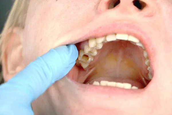 Buraco Dente Tratamento Dos Canais Dentários Tratamento Periodontite Clínica Odontológica — Fotografia de Stock