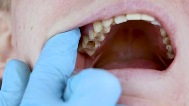 Buraco Dente Tratamento Dos Canais Dentários Tratamento Periodontite Clínica Odontológica — Vídeo de Stock