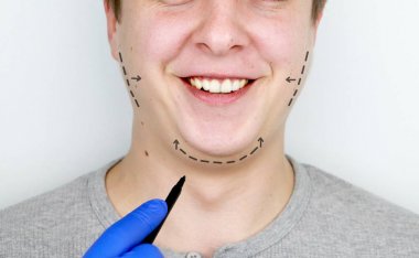 Chin lift - mentoplasty. A man at the reception at the plastic surgeon. Preparation for surgery clipart