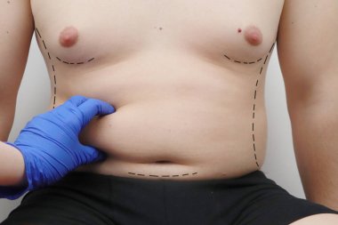 Karın germe, liposuction, meme cerrahisi. Bir plastik cerrah plastik cerrahi için bir adam hazırlar.