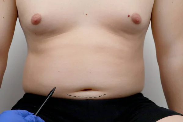 おなかタック 脂肪吸引 乳房手術 整形外科医は 整形手術のための男を準備します — ストック写真