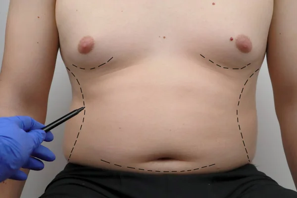 Abdominoplastia Liposucción Cirugía Senos Cirujano Plástico Prepara Hombre Para Cirugía — Foto de Stock