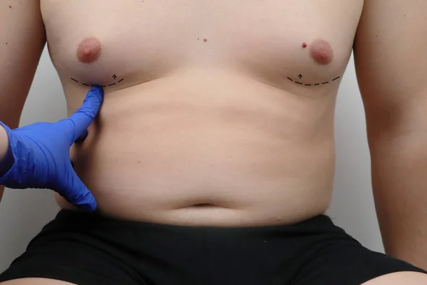 Tummy Tuck Lipoaspiração Cirurgia Mamária Cirurgião Plástico Prepara Homem Para — Fotografia de Stock