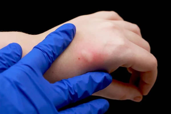 Enrojecimiento Picazón Brazo Médico Examina Mano Que Pica Insecto Mosquito —  Fotos de Stock