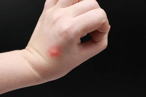 手臂上发红和发痒 医生检查了昆虫 蚊子咬手的手 — 图库照片