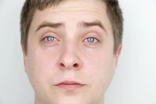 Οφθαλμολογική Αλλεργίες Σχίσιμο Πορτρέτο Ενός Άντρα Που Κλαίει — Φωτογραφία Αρχείου