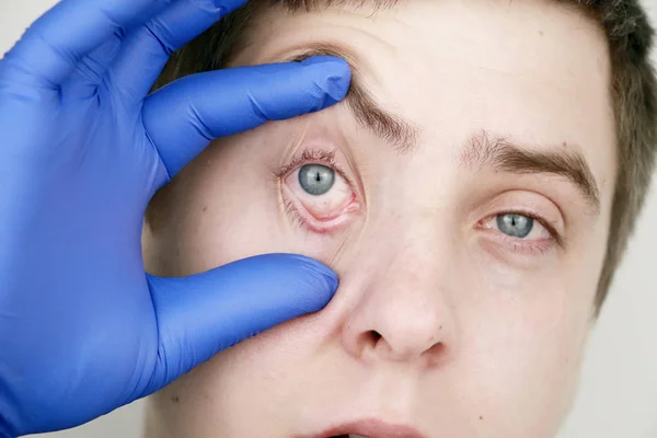 Мужчину Осматривает Офтальмолог Страшное Зрелище Глаза Покраснением Разрывом — стоковое фото