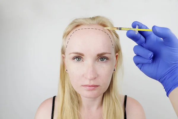 Haar Mesotherapie Haartransplantatie Een Schoonheidsspecialiste Arts Maakt Injecties Het Hoofd — Stockfoto