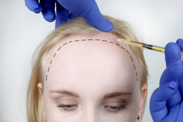Hair mesotherapy or hair transplant: a beautician doctor makes injections in the head of a woman for hair growth or to prevent baldness