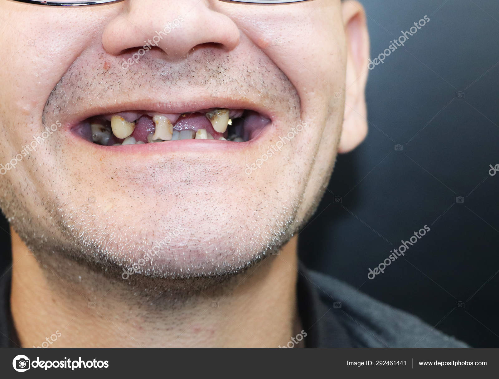 Man Has Rotten Teeth Teeth Fell Out Yellow Black Teeth Stock Photo by  ©Alena1919 292461441