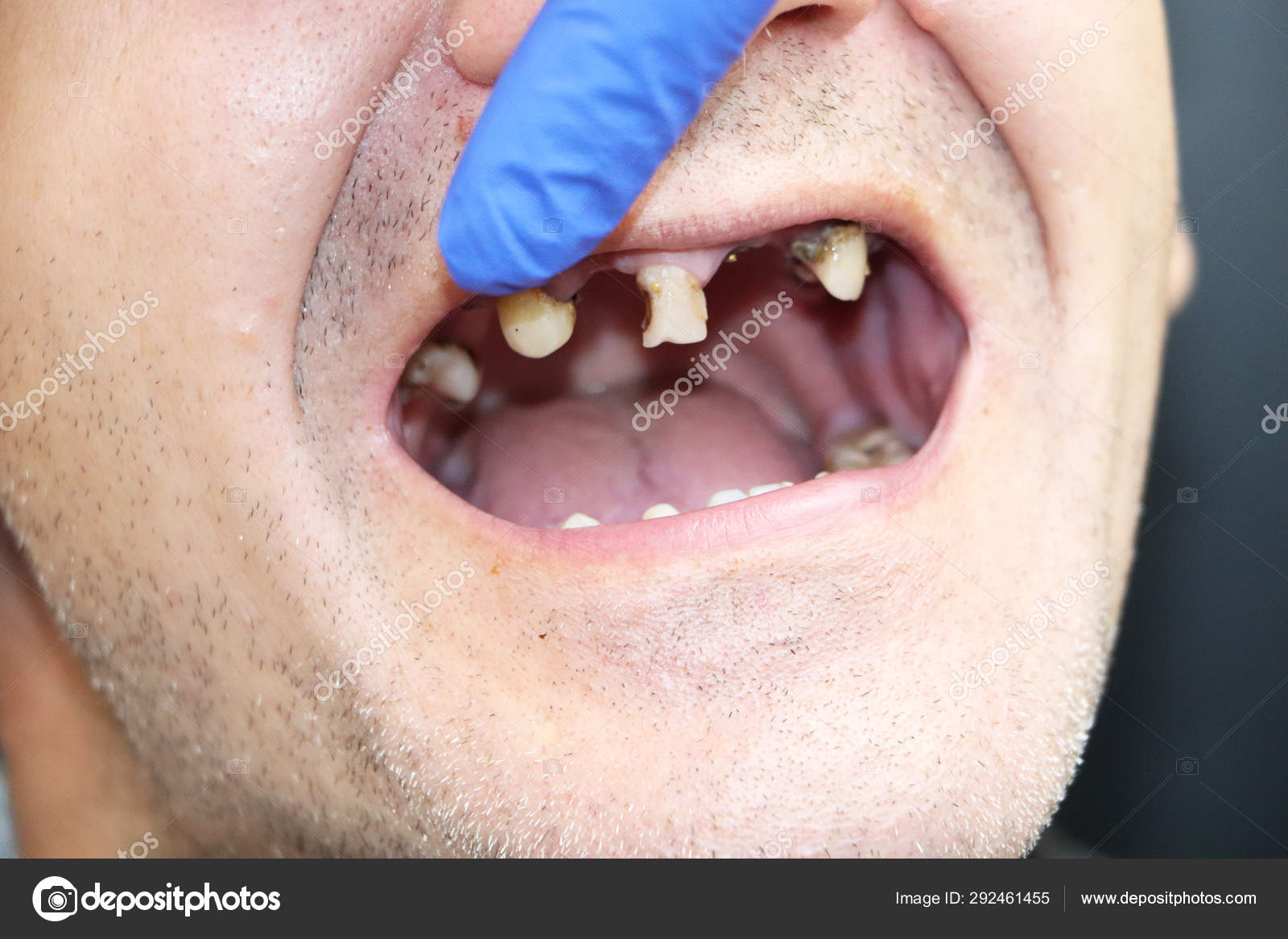 L'homme Des Dents Pourries Des Dents Tombées Des Dents Jaunes image libre  de droit par Alena1919 © #292461455