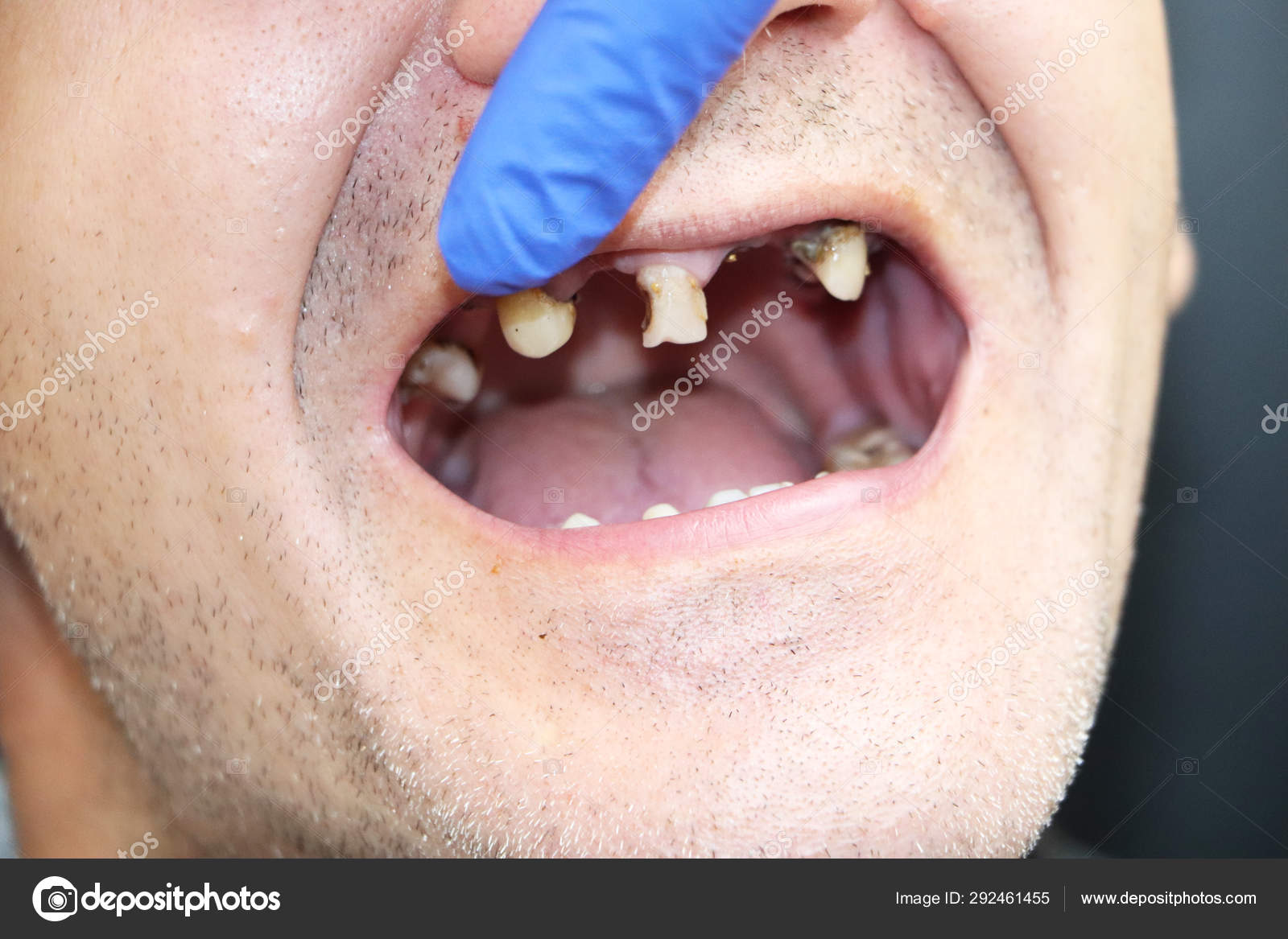 Man Has Rotten Teeth Teeth Fell Out Yellow Black Teeth Stock Photo By C Alena1919 Man Has Rotten Teeth Teeth Fell Out Yellow Black Teeth Stock Photo By C Alena1919