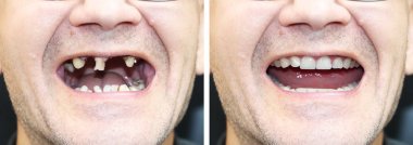 Dental implantların kurulmasından önce ve sonra ortodontist hasta. Diş kaybı, çürümüş dişler, protezler, kaplamalar