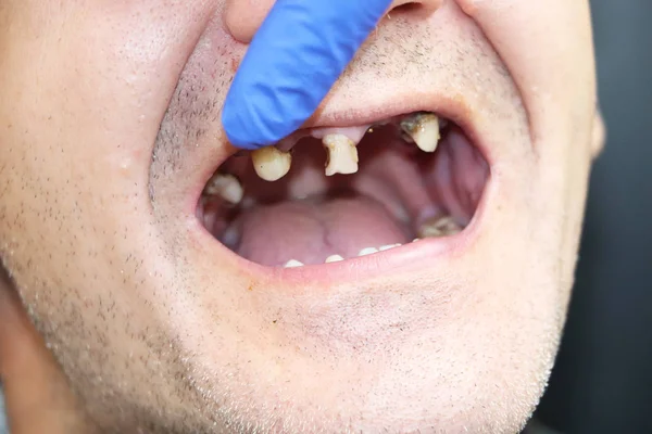 Homem Tem Dentes Podres Dentes Caídos Dentes Amarelos Pretos Feridos — Fotografia de Stock