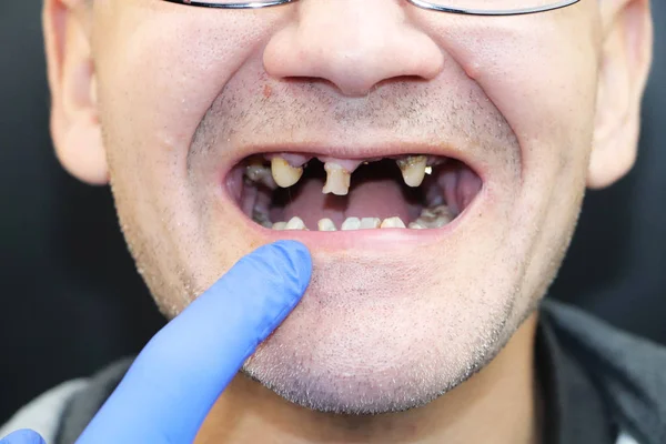 Ten Chlap Zkažené Zuby Vypadly Zuby Bolely Žluté Černé Zuby — Stock fotografie