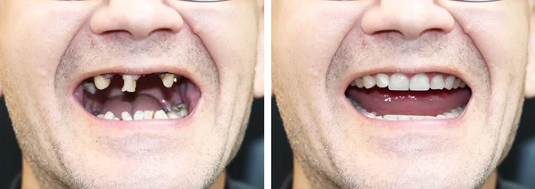 Paciente Ortodontista Antes Após Instalação Dos Implantes Dentários Perda Dentes — Fotografia de Stock