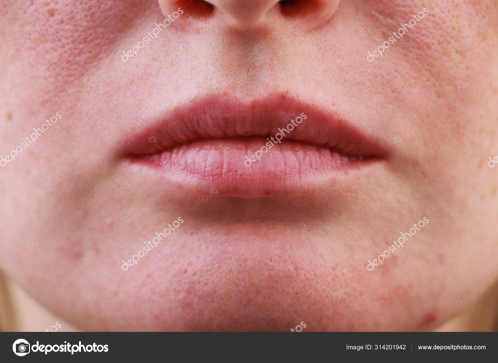 Expanded Pores Acne Comedones Black Spots Lips Close Problem Skin