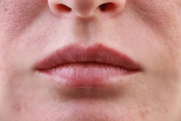 Poros Expandidos Acne Comedões Manchas Pretas Lábios Perto Problema Menina — Fotografia de Stock