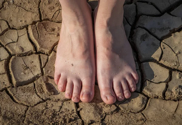 Πόδια Μιας Γυναίκας Στέκονται Πάνω Ραγισμένη Έννοια Του Ξηρού Δέρματος — Φωτογραφία Αρχείου