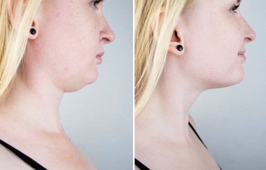 Second chin lift in women. Photos before and after plastic surgery, mentoplasty or facebuilding. Chin fat removal and face contour correction clipart