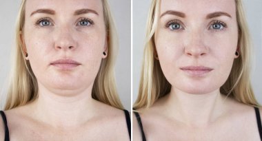 Kadınlarda ikinci çene gerdirme. Estetik ameliyat öncesi ve sonrası fotoğraflar, mentoplasti ya da yüz geliştirme. Çene yağlarını aldırma ve yüz hatlarını düzeltme