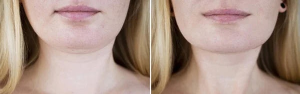 女性で2番目のあごのリフト 形成外科手術前と後の写真 造形や顔の建物 あごの脂肪除去と顔の輪郭補正 — ストック写真