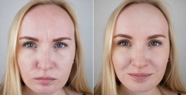 Mezoterapiden önce ve sonra fotoğraflar, biyo-evitalizasyon, botulinyum toksin enjeksiyonları. Kaşların arasındaki deri kıvrımı, alın kırışıklıkları. Estetik cerrah ya da kozmetikçiyle randevuda.