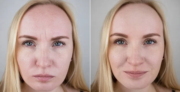 Photos before and after mesotherapy, biorevitalization, botulinum toxin injections. Skin fold between eyebrows, forehead wrinkles. At the appointment with a plastic surgeon or cosmetologist