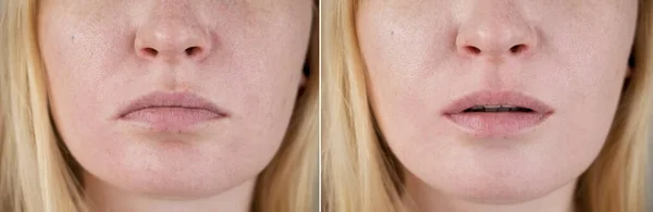 Fotos Weiblicher Lippen Vor Und Nach Der Cheiloplastik Korrektur Des — Stockfoto