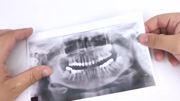歯医者は問題のある患者の歯の写真を検査し 歯を挿入する 研究と診断の概念 マクロビデオ — ストック動画