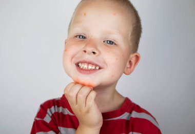 Bir alerji uzmanı ya da dermatolog bir çocuğun yüzündeki kırmızı noktaları inceler. Çocuk kurdeşen döküyor, kurdeşen döküyor ve kaşınıyor. Yiyecek Alerjisi, Böcek Isırığı, Kızamık veya Suçiçeği