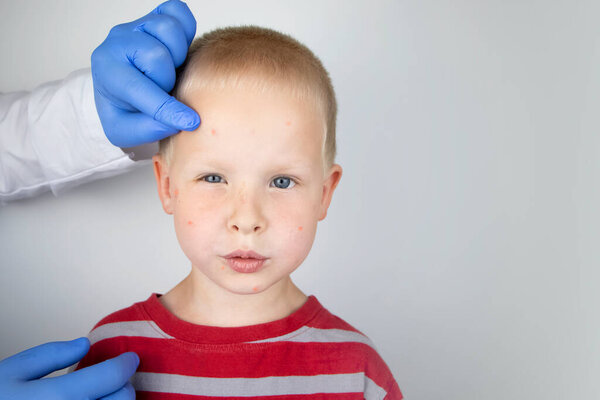 An allergist or dermatologist examines red spots on a child's face. The boy suffers from a rash, hives and itching. Food Allergy, Insect Bite, Measles or Chicken Pox