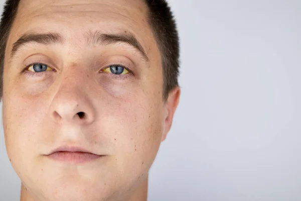 Gele Kleur Van Het Mannelijke Oog Symptoom Van Geelzucht Hepatitis — Stockfoto