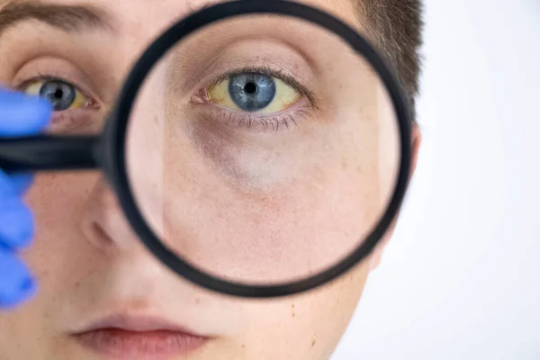 Die Gelbe Farbe Des Männlichen Auges Symptome Von Gelbsucht Hepatitis — Stockfoto