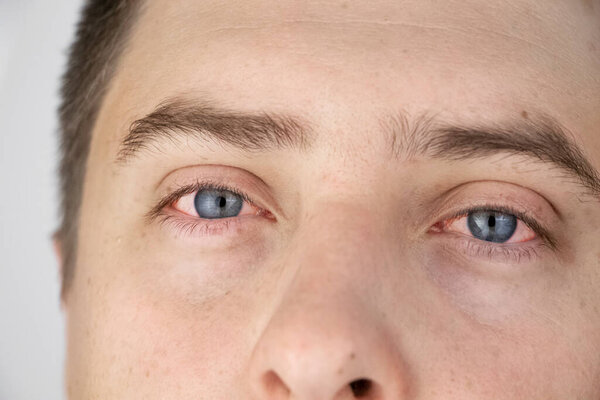 Крупным планом два раздраженных красных глаза крови мужчины, пострадавшего от конъюнктивита или после гриппа, холодный, аллергия. Копировать место для рекламы. Устали глаза после работы за компьютером. Крупный план и макрос
