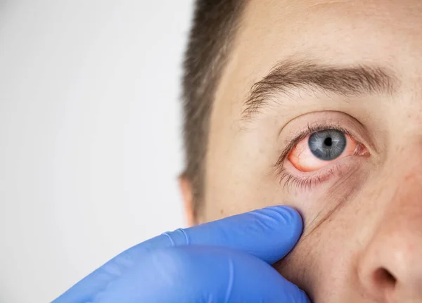 Close Two Annoyed Red Blood Eyes Male Affected Conjunctivitis Flu — Stock Photo, Image