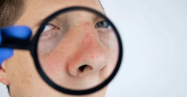 Akne Närbild Man Undersöks Läkare Dermatolog Undersöker Huden Genom Förstoringsglas — Stockfoto